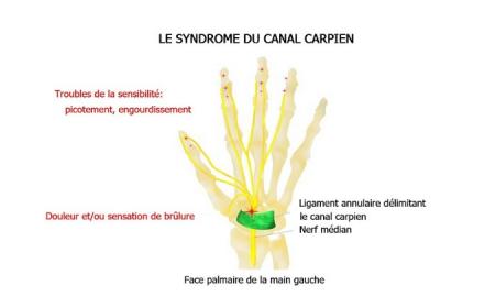 Le syndrome du canal carpien : une prise en charge efficace par l'étiopathie ?